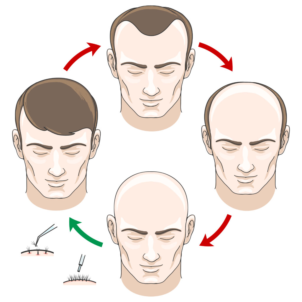 Diagram Showing Hair Follicle Shrinking In Male Pattern Baldness
