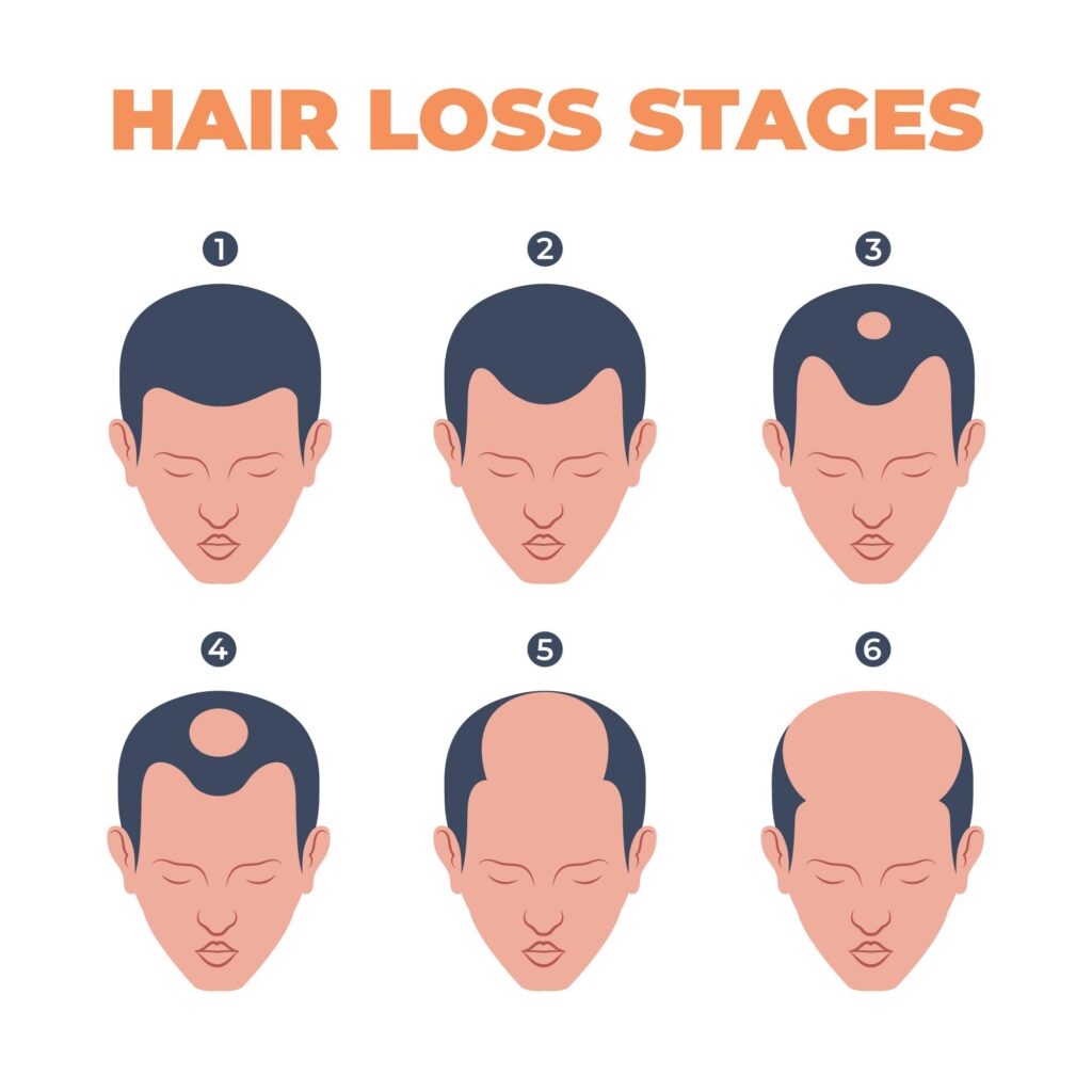 Stages Of Male Pattern Baldness On The Scalp